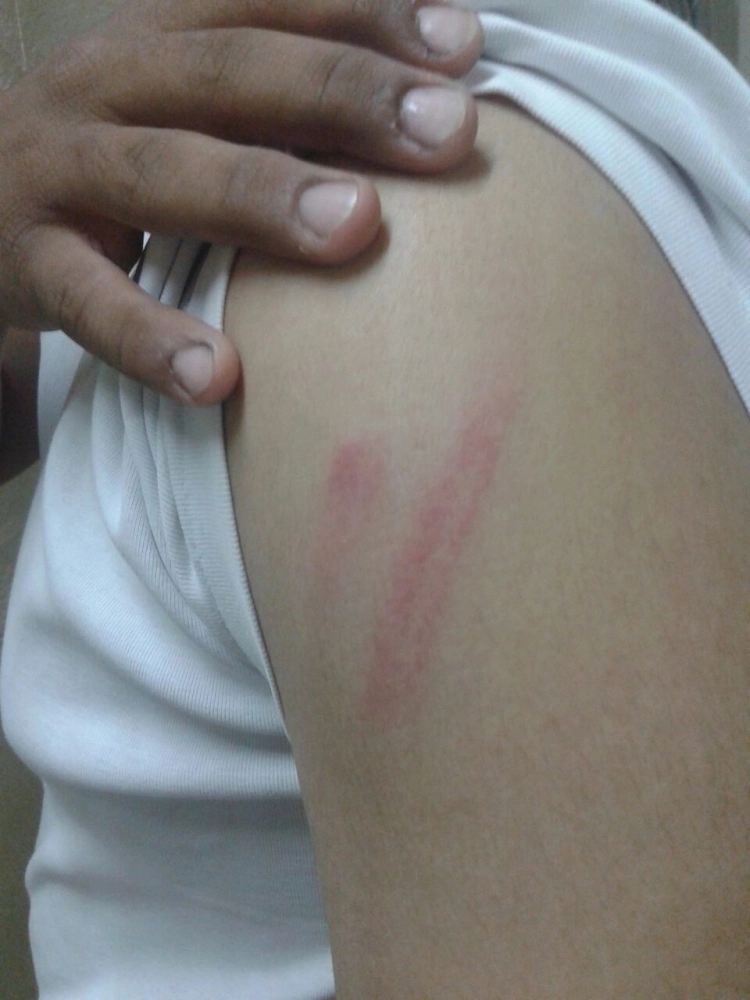 آثار الضرب على جسم الطالب (مكة)