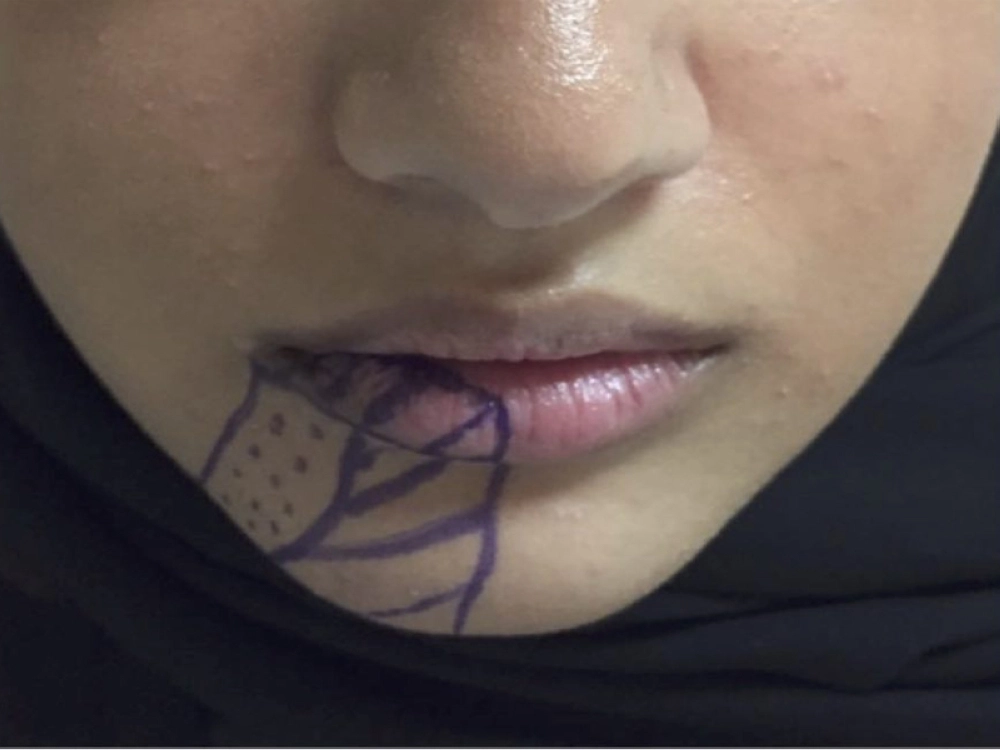 الجزء المظلل يمثل المنطقة التي فقدت المريضة الإحساس بها كلياً قبل العملية، وفي الأسابيع الأولى بعد العملية بدأ الإحساس يعود إليها تدريجياً حتى التماثل للشفاء