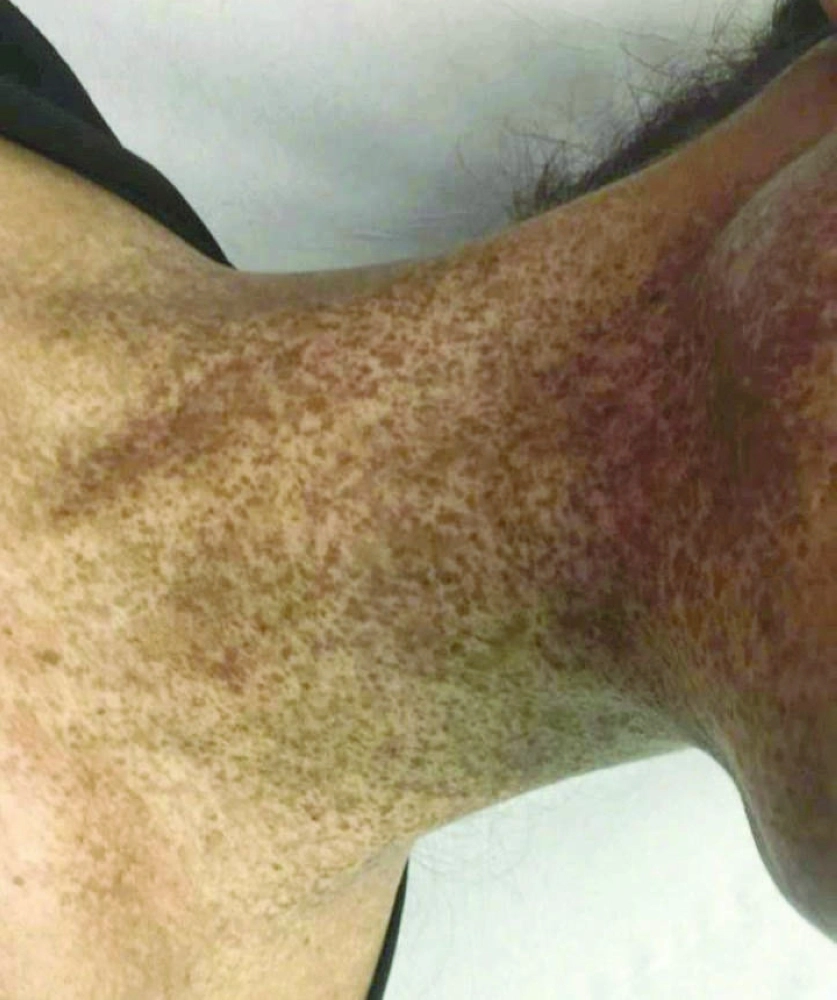 آثار الحروق على عنق الفتاة           (مكة)