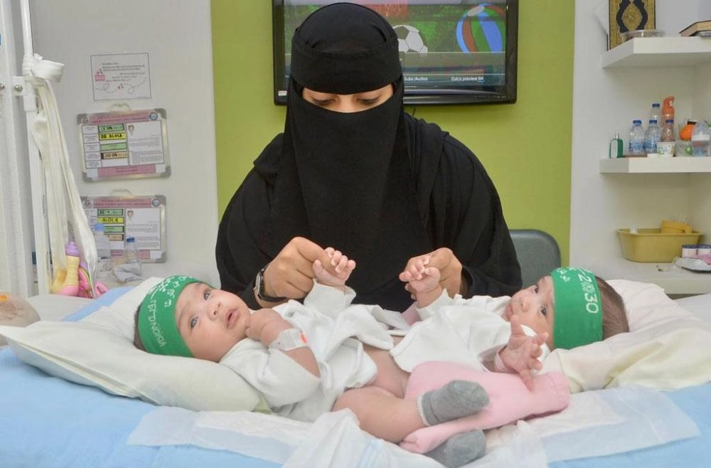 التوأم السيامي شيخة وشموخ (مكة)