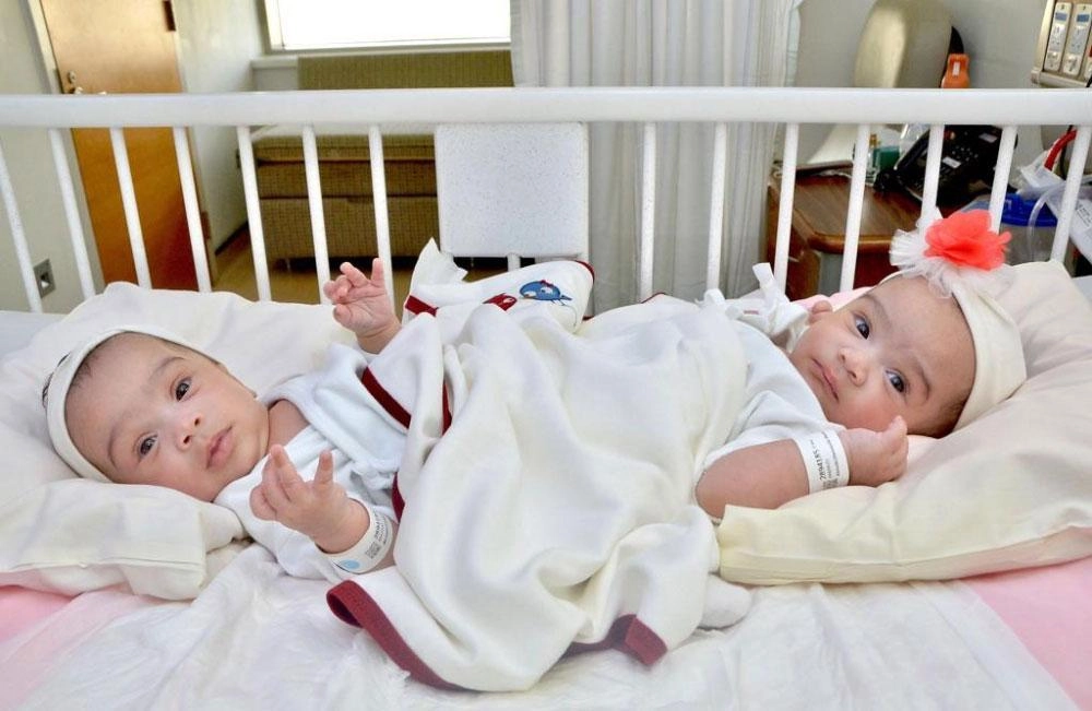 التوأم السيامي شيخة وشموخ (مكة)