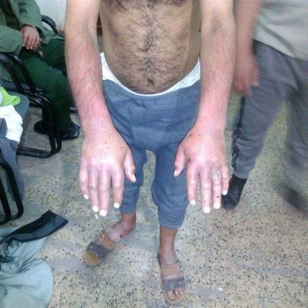 من ضحايا التعذيب الحوثي (تويتر)