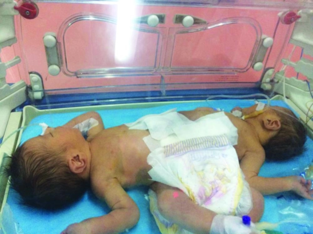  التوأم السيامي الليبي (مكة)