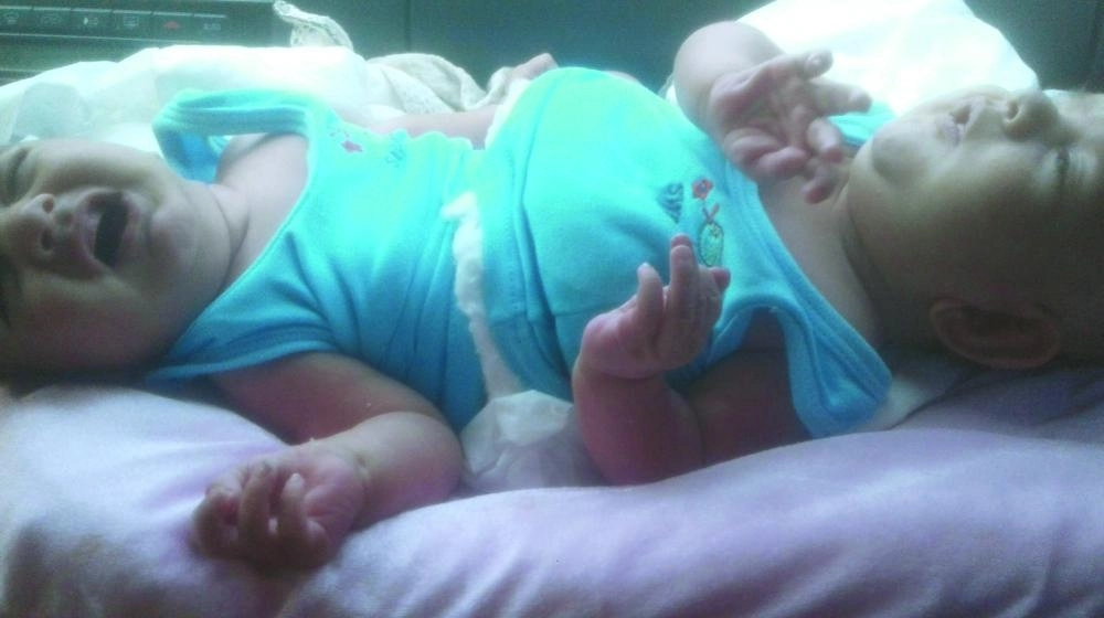  التوأم السيامي الليبي (مكة)