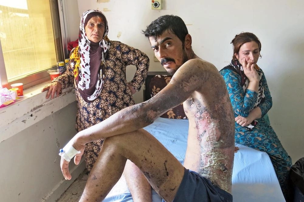 






كردي مصاب بمواد كيميائية حارقة                          (مكة)