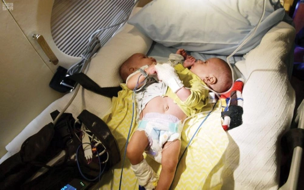 التوأم السيامي