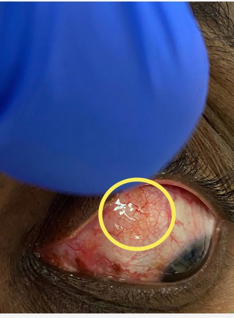 






احمرار وتورم العين                     (مكة)