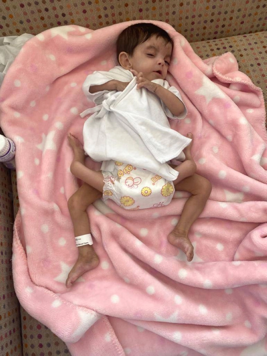 إجراء عملية فصل التوأم الطفيلي اليمني عائشة غدًا