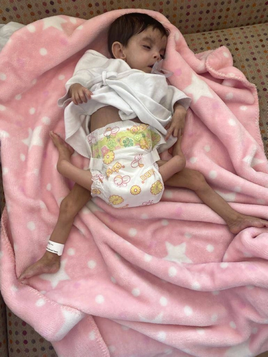 إجراء عملية فصل التوأم الطفيلي اليمني عائشة غدًا