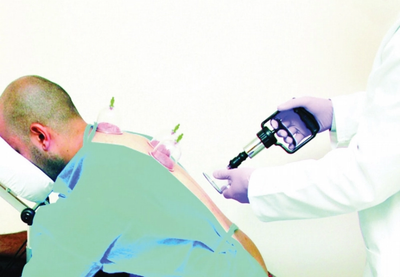من إجراءات الحجامة بأدوات حديثة (مكة)