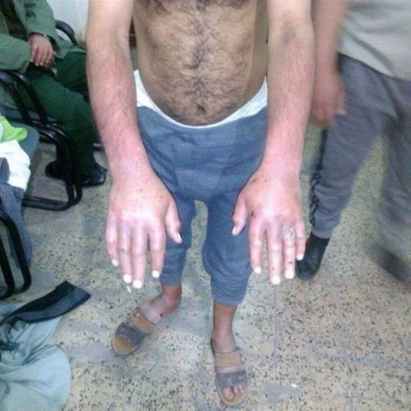 من ضحايا التعذيب الحوثي (تويتر)