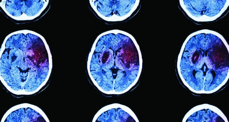 السكتة الدماغية (Science News)
