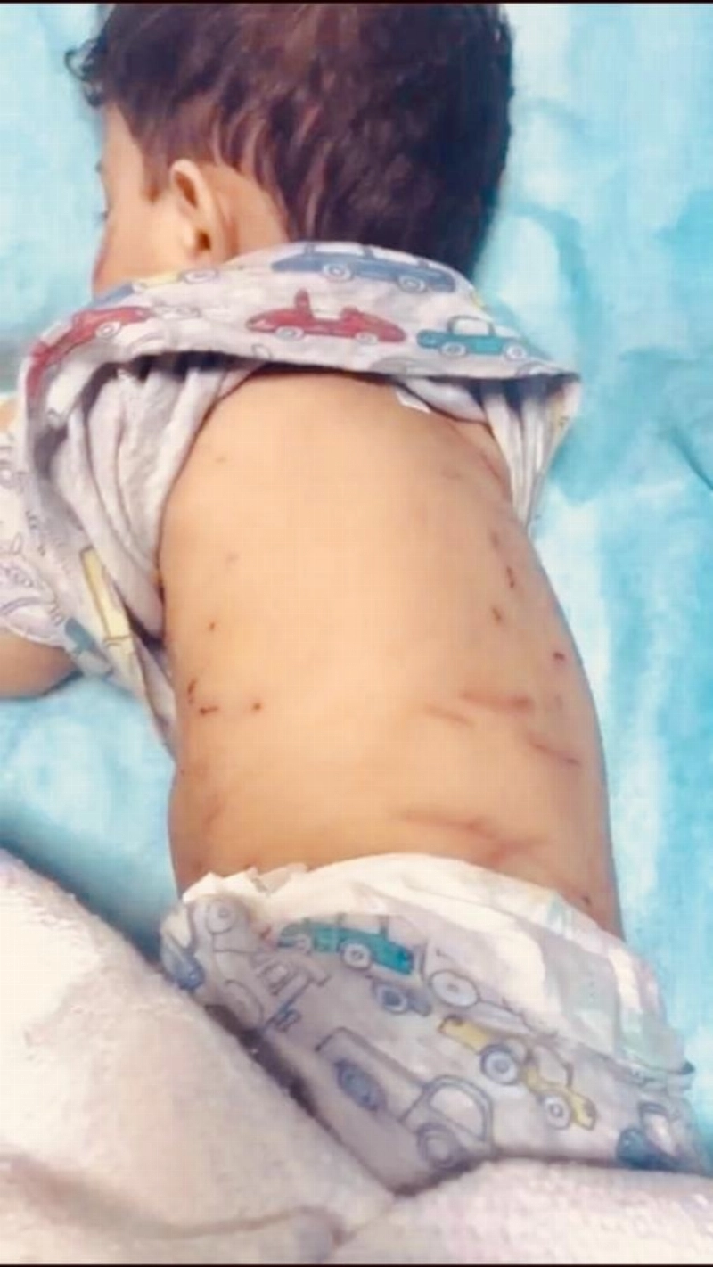 جسم الطفل بعد الحادثة