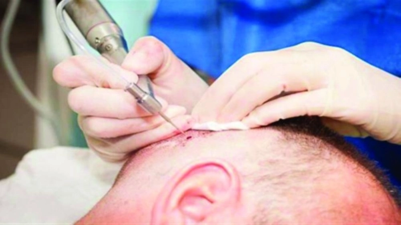 زراعة الشعر في تركيا (مكة)
