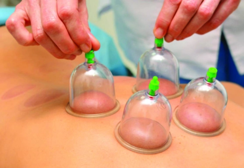أدوات تستخدم في الحجامة (مكة)
