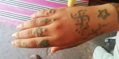 Effacer les tatouages infâmes mais aussi surmonter la douleur profonde causée par un tel traumatisme