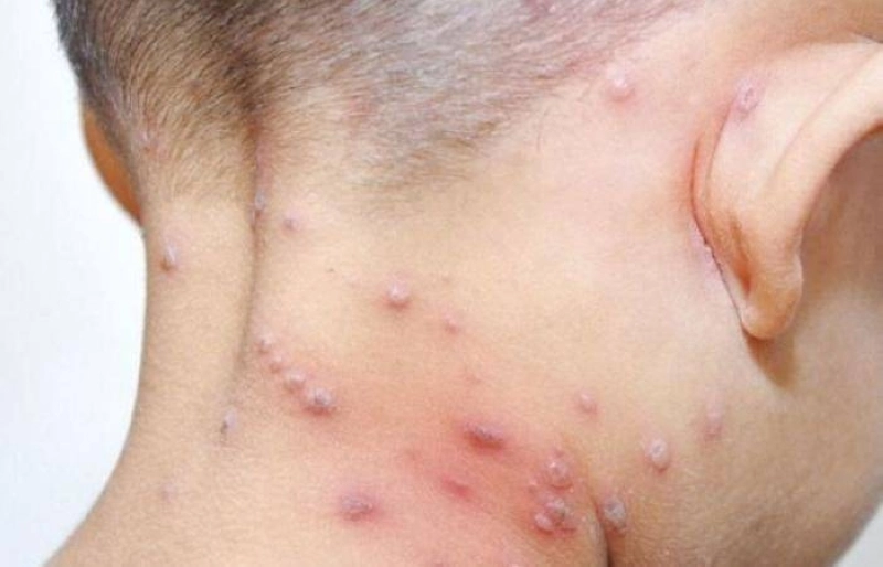 La variole du singe se caractérise par ses impressionnantes pustules