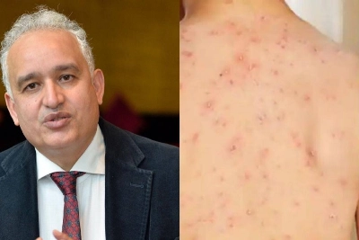 Dr. Tayeb Hamdi démystéfie la variole du singe