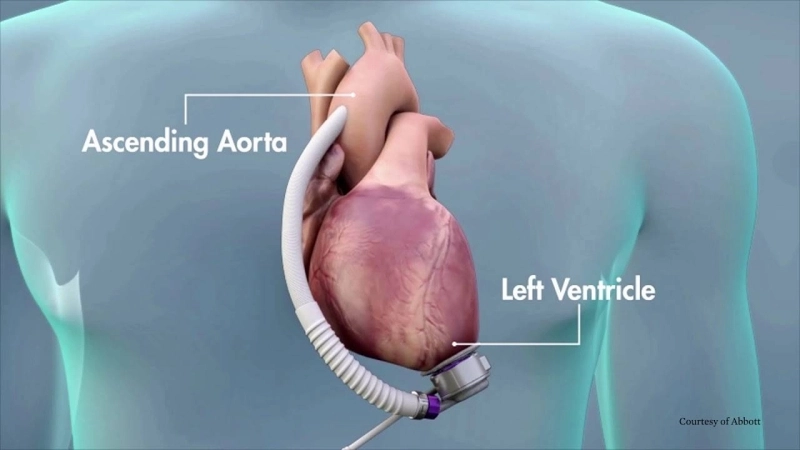 Il est tout à fait possible d'avoir une vie assez normale avec le LVAD