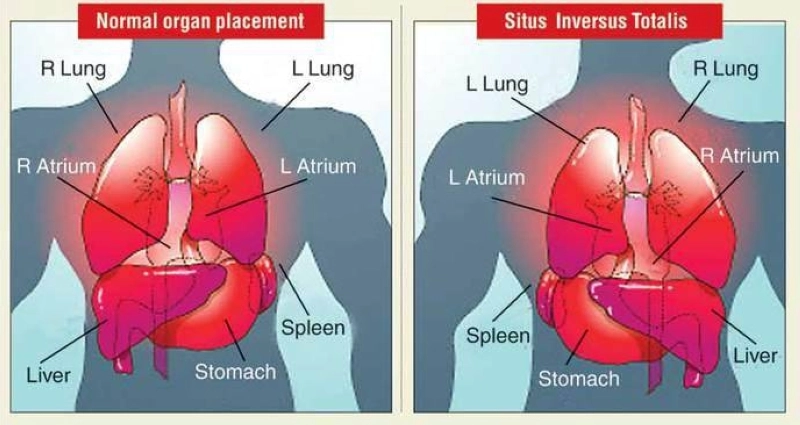 " Situs inversus " anomalie congénitale très rare