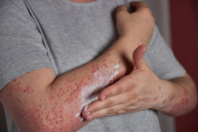 La rougeole marque d'une manière très visible les personnes touchées - Ph. Freepik