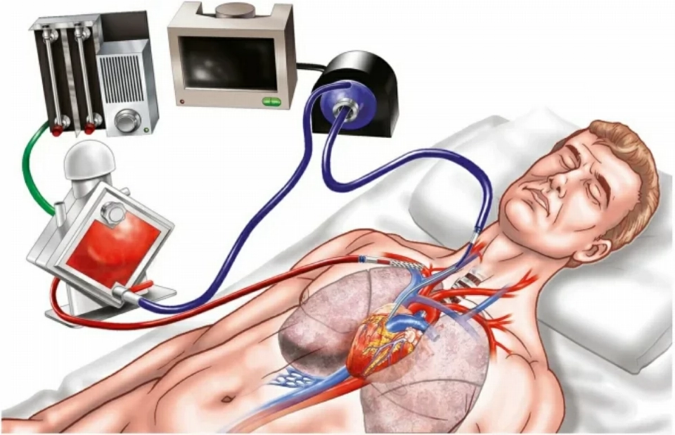 رسم لتقنية ECMO