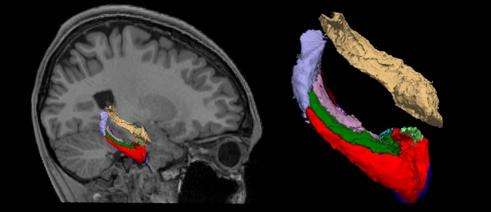 The hippocampus is a part of the brain that controls memory, learning and emotions. Stressful life events such as disasters and terrorist attacks are known to lead to post-traumatic stress disorder and result in its shrinkage. The hippocampus is a part of the brain that controls memory, learning and emotions. Stressful life events such as disasters and terrorist attacks are known to lead to post-traumatic stress disorder and result in its shrinkage.