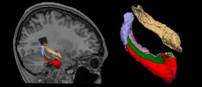 The hippocampus is a part of the brain that controls memory, learning and emotions. Stressful life events such as disasters and terrorist attacks are known to lead to post-traumatic stress disorder and result in its shrinkage. The hippocampus is a part of the brain that controls memory, learning and emotions. Stressful life events such as disasters and terrorist attacks are known to lead to post-traumatic stress disorder and result in its shrinkage.