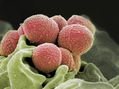 Streptococcal Toxic Shock Syndrome (STSS) is caused by bacteria called group A streptococcus, the same type that causes a strep throat infection, which affects mostly children. A strep A throat infection is not the same as STSS, however. Streptococcal Toxic Shock Syndrome (STSS) is caused by bacteria called group A streptococcus, the same type that causes a strep throat infection, which affects mostly children. A strep A throat infection is not the same as STSS, however.