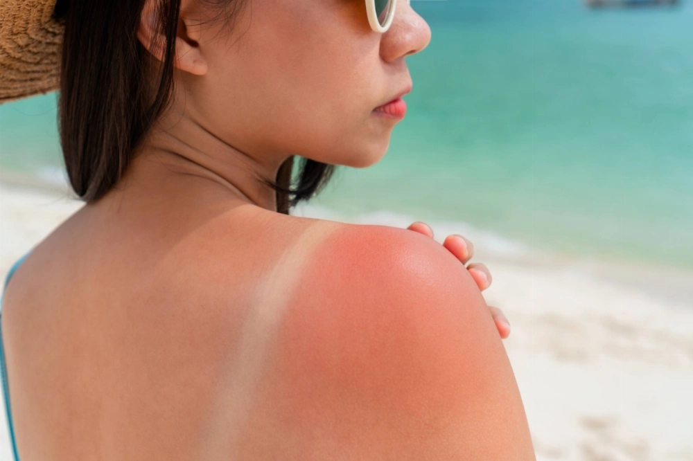 If you're still trying to be active during Japan's record-setting heat, you should also know how best to care for yourself when you inevitably get a sunburn. If you're still trying to be active during Japan's record-setting heat, you should also know how best to care for yourself when you inevitably get a sunburn.