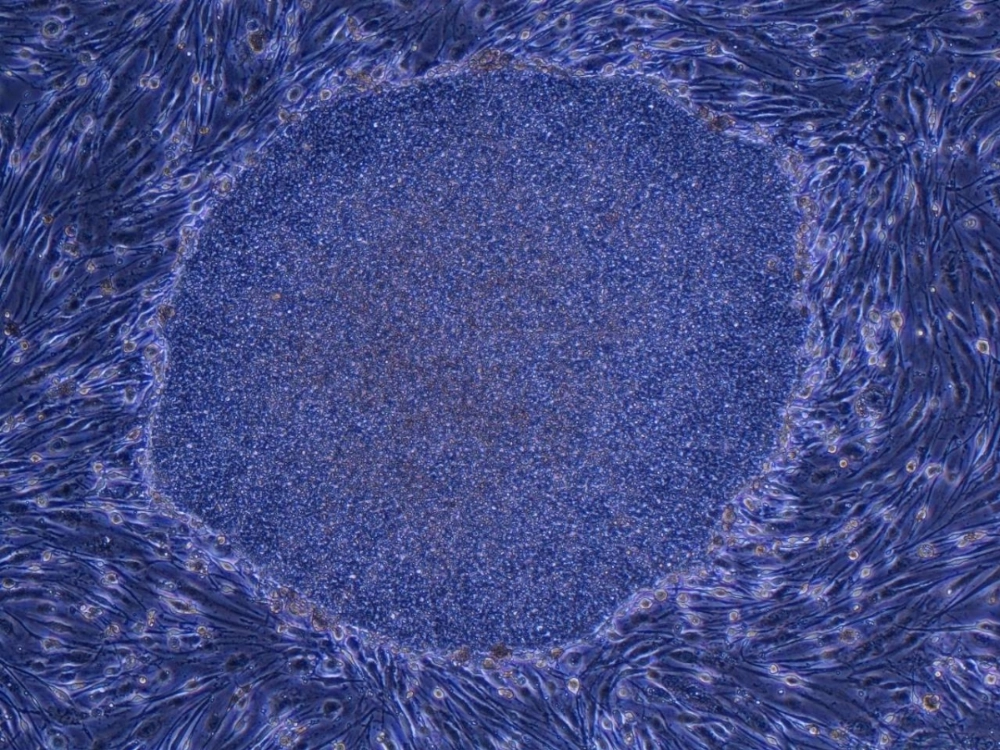 A colony of human induced pluripotent stem (iPS) cells established from fibroblasts. Kyoto University Hospital is looking to develop a treatment for Type 1 diabetes using iPS cells. A colony of human induced pluripotent stem (iPS) cells established from fibroblasts. Kyoto University Hospital is looking to develop a treatment for Type 1 diabetes using iPS cells.