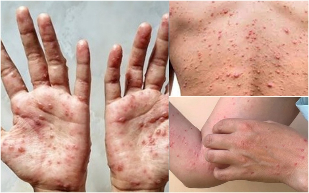Health Ministry says no plans to implement mpox vaccination programe in ...