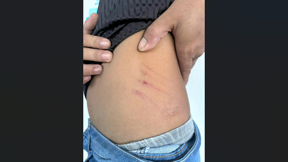 Sarawak housewife held after alleged scissor attack on husband who refused divorce The complainant shows the scratches caused by the alleged attack. — The Borneo Post pic