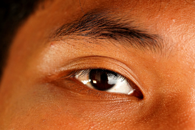 Droopy eyelids may signal underlying health condition, not just cosmetic issue What may be mistaken for tired-looking eyes, uneven eyelids or a reason for cosmetic eyelid surgery could, in some cases, a droopy eyelid or ptosis may signal an underlying condition, according to Consultant Ophthalmologist and Oculoplastic Surgeon at Sunway Medical Centre Velocity (SMCV), Dr Nazila Ahmad Azli. — Pexels.com pic