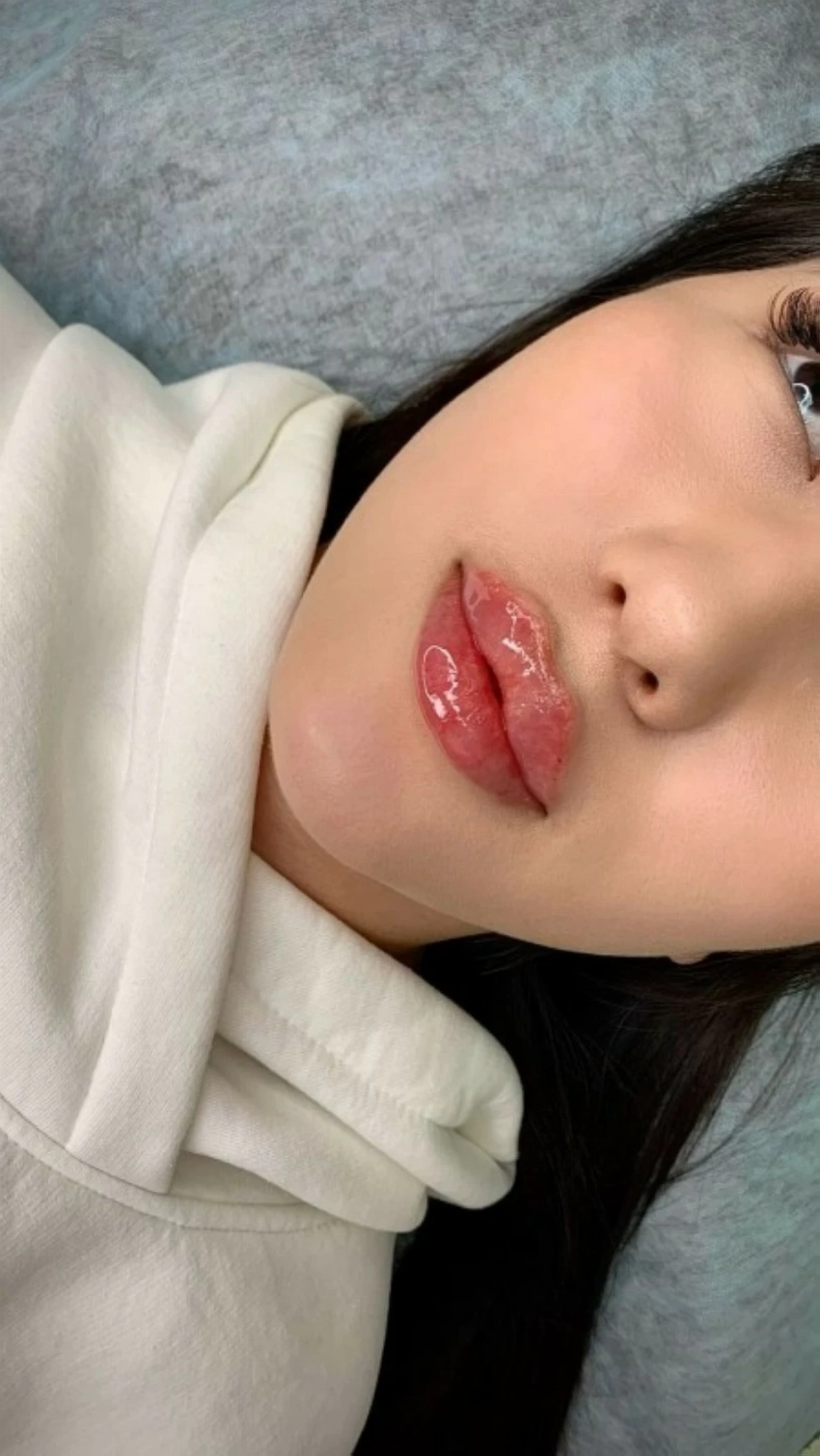 فيلر الشفاه الروسية.. صيحة جمالية أم موضة عابرة؟