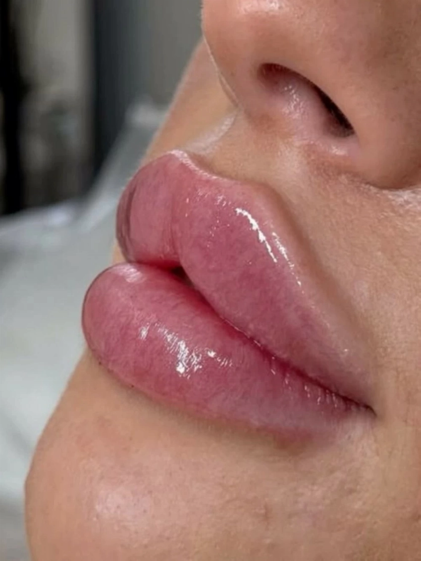 فيلر الشفاه الروسية.. صيحة جمالية أم موضة عابرة؟