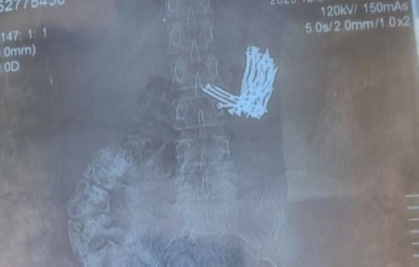 صدمة طبية في مصر: استخراج 34 مسماراً من معدة سيدة دون جراحة - أخبار السعودية 2 المسامير ظلت داخل معدة مريضة لمدة 45 يوماً.