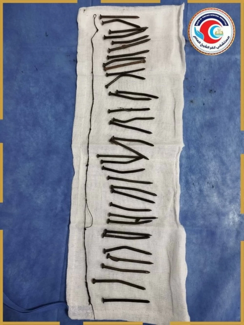 صدمة طبية في مصر: استخراج 34 مسماراً من معدة سيدة دون جراحة - أخبار السعودية 1 استخراج المسامير دون جراحة.