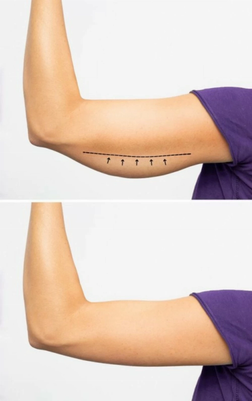 شد الجسم ونحت القوام بعد إبر التخسيس