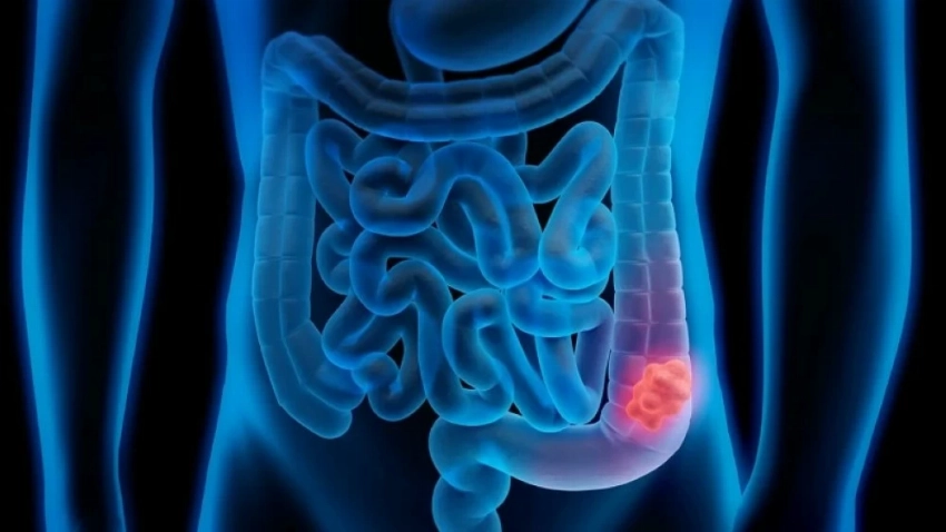 سرطان القولون والمستقيم