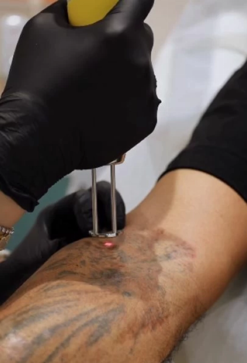 الفنان أحمد سعد أثناء خضوعه لإزالة الوشم من ذراعه.