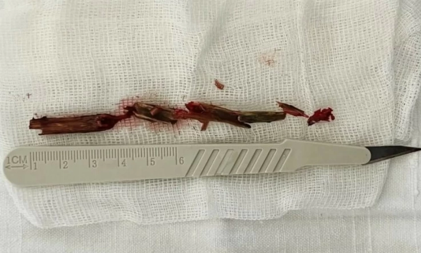أطباء يكتشفون غصناً خشبياً بطول 12 سم داخل جمجمة رجل روسي